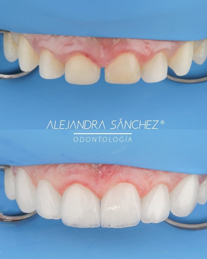 Antes y después de diseño de sonrisa en Colombia: cierre de espacio y carillas cerámicas