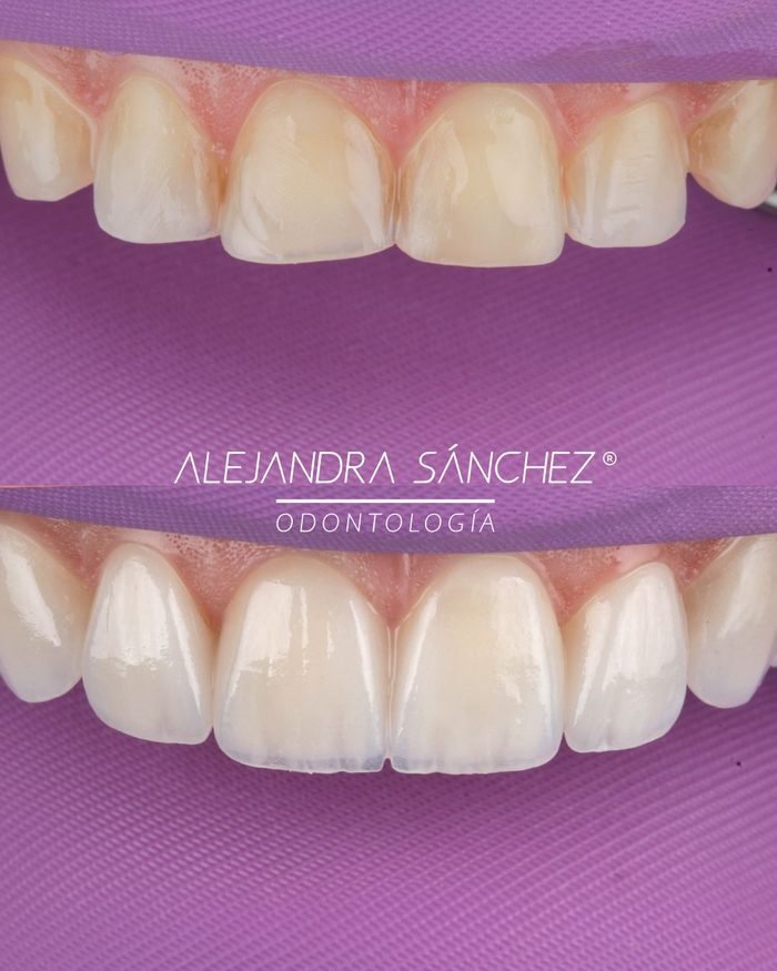 Antes y después de diseño de sonrisa en Colombia: carillas cerámicas para corregir color