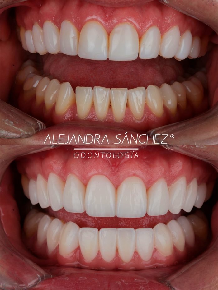 Antes y después de rehabilitación oral en Colombia: arcada superior e inferior completa